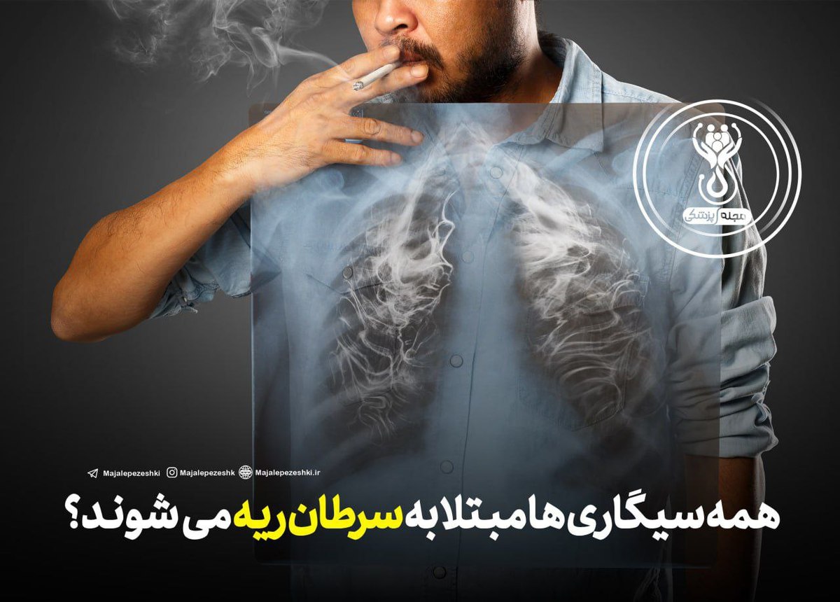 آیا همه سیگاری‌ها سرطان ریه می‌گیرند؟ بررسی رابطه بین سیگار و سرطان ریه