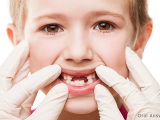 توصیه‌ هـایی برای قبل و بعد از کنده شدن دندان شیری