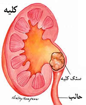 همه چیز در مورد سنگ کلیه