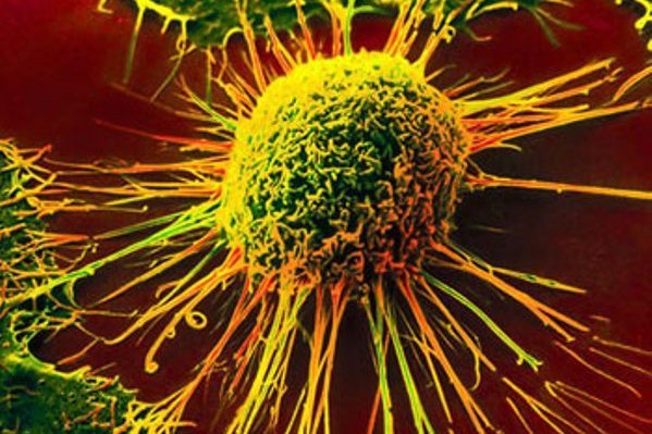 8 راه طبيعي و کم خرج براي پيشگيري از سرطان سينه