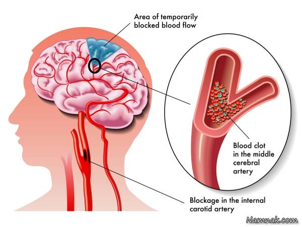 سکته مغزی چطور از راه می­رسد؟