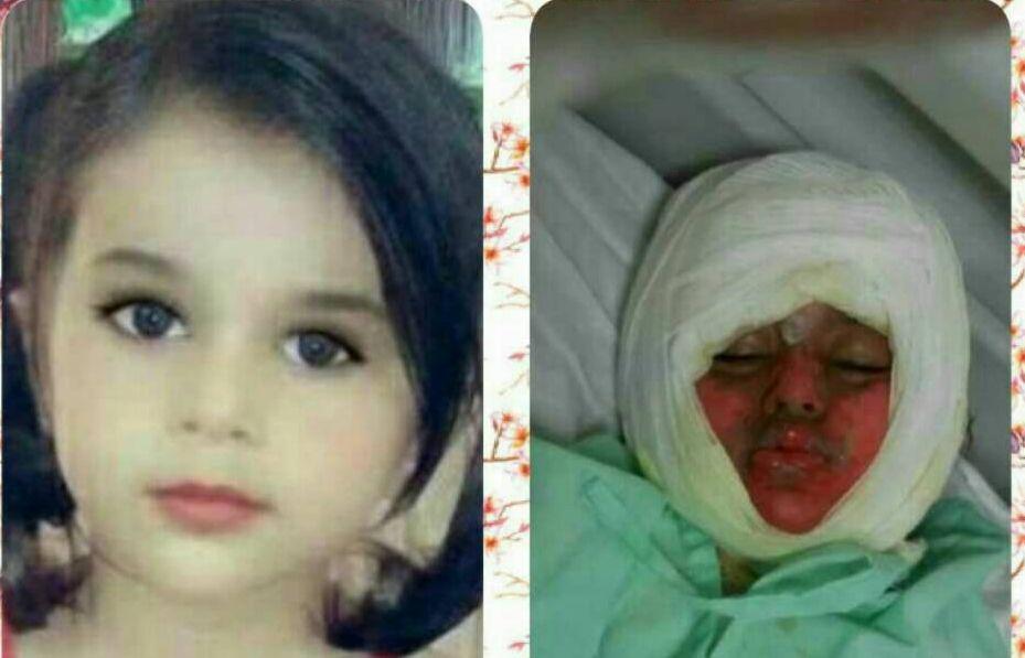 دختر بچه ای که در دیگ نذری سقوط کرده بود فوت کرد +عکس
