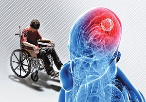 ام اس بیماری خطرناک در کمین جوانان