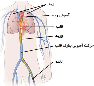 آمبولی ریه چیست؟