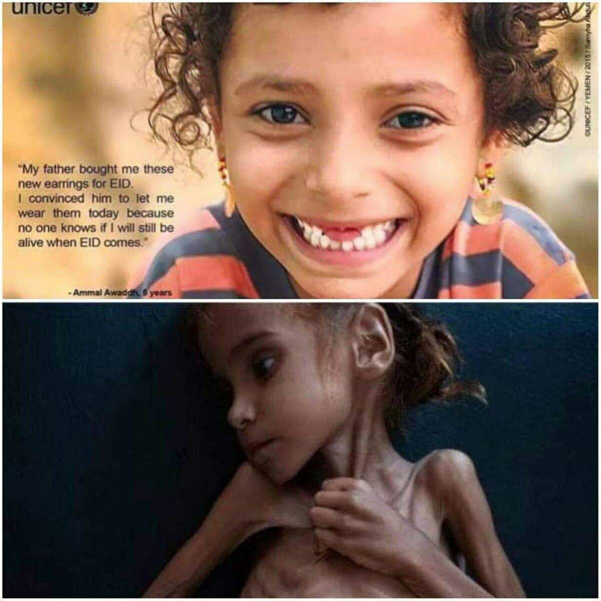 مرگ دختر یمنی که تصویرش جهان را تکان داد