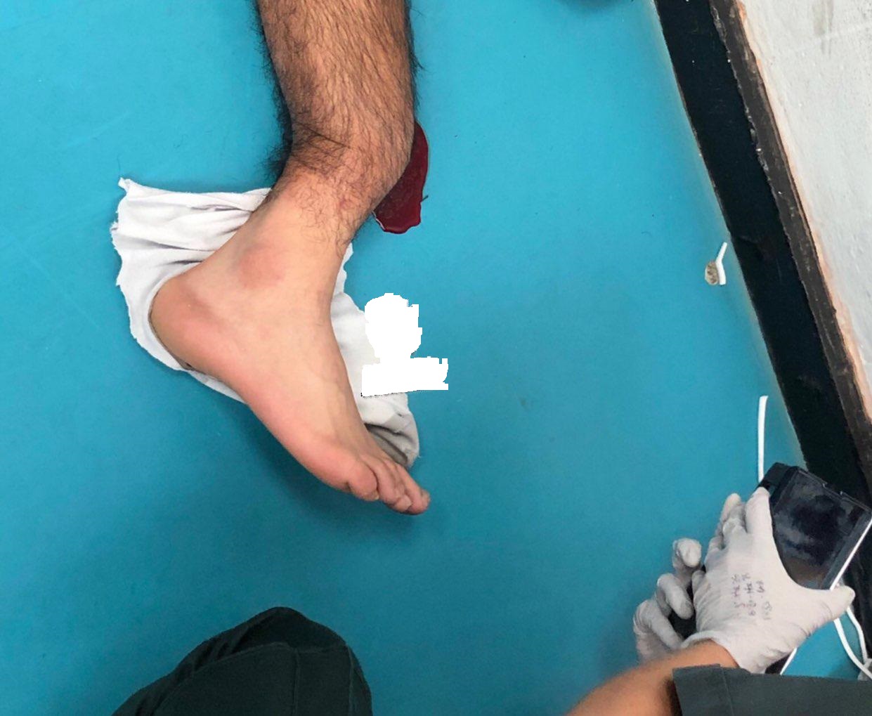 اولین تصویر از پای له شده گومز بعد از اتمام بازی