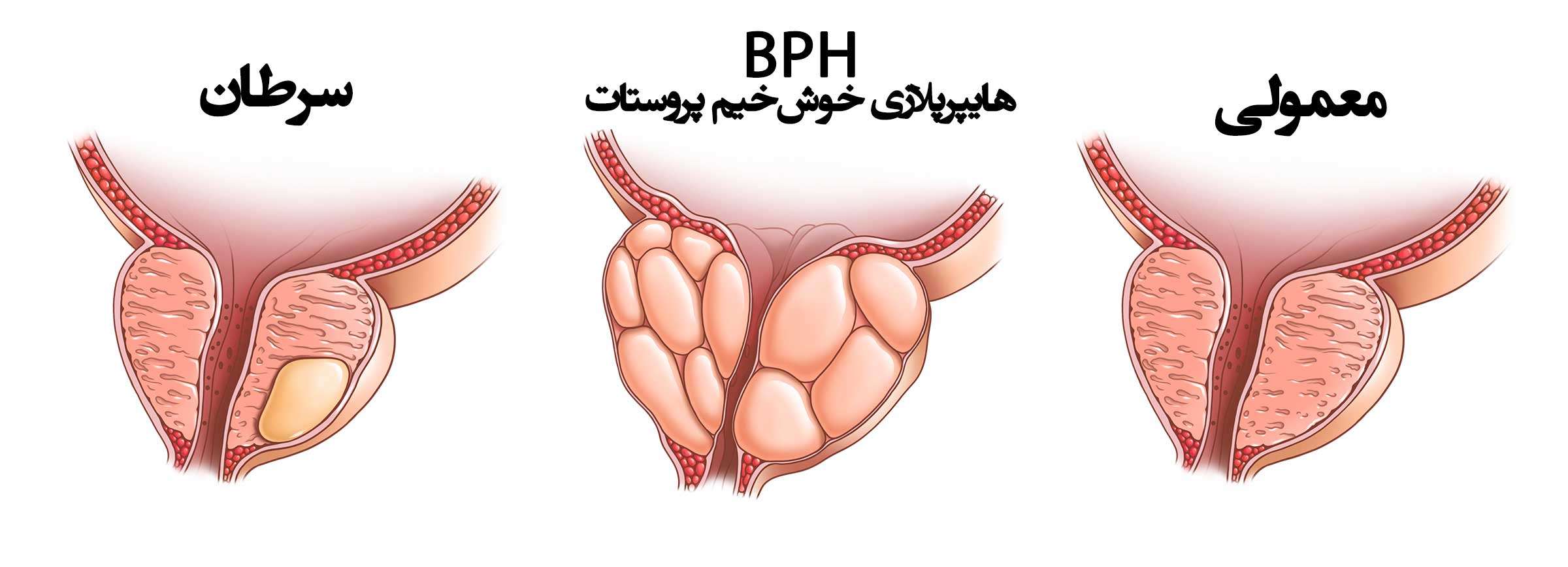 راه جلو گیری از ابتلا به بیماری پروستات