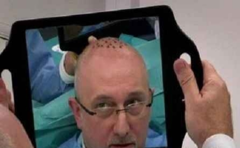 جراحی کاشت مو، کار دست این مرد کچل داد + عکس