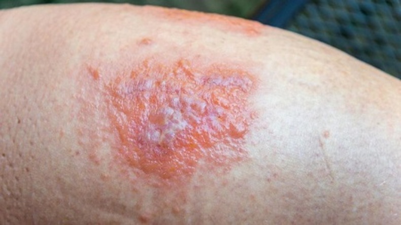 علل ایجاد لکه های روی پوست پا چیست و چگونه درمان می شود؟