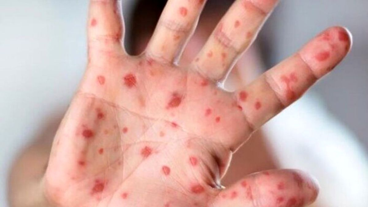 عفونت مغزی و کوری از عوارض بیماری سرخک است