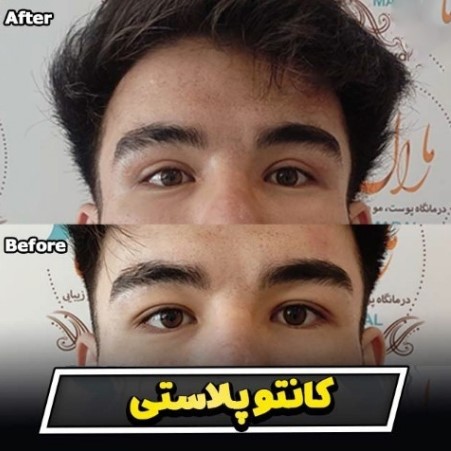 بهترین کلینیک عمل چشم گربه ای