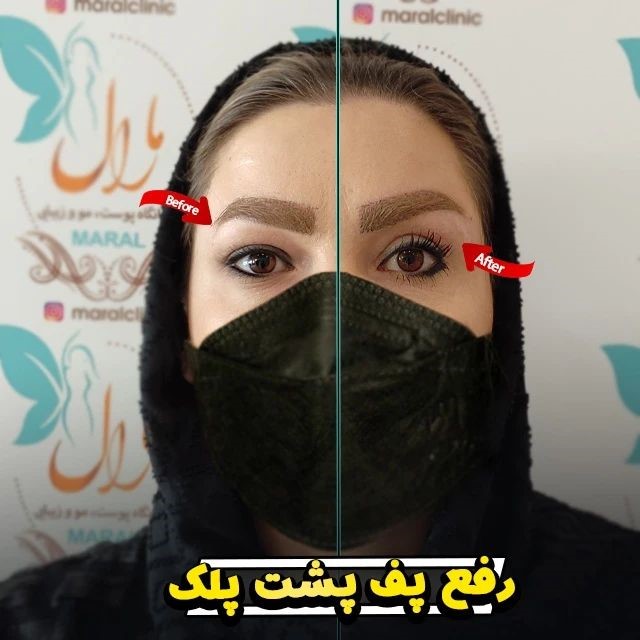 بهترین سن برای عمل بلفاروپلاستی