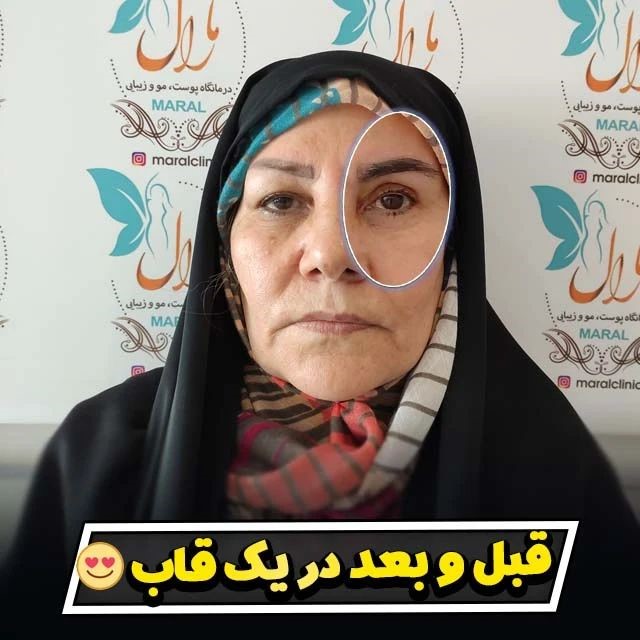 بهترین سن برای عمل بلفاروپلاستی