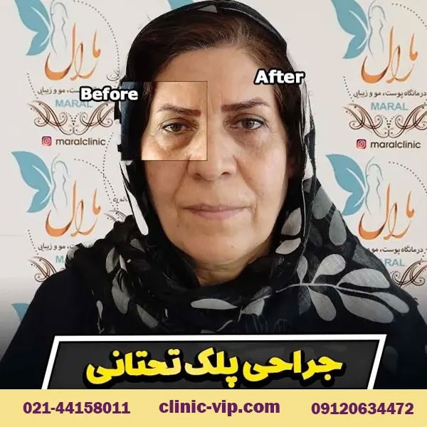 آیا درمان افتادگی پلک در تهران دائمی است؟