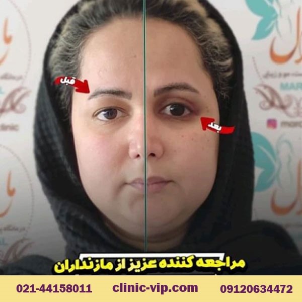 آیا درمان افتادگی پلک در تهران دائمی است؟