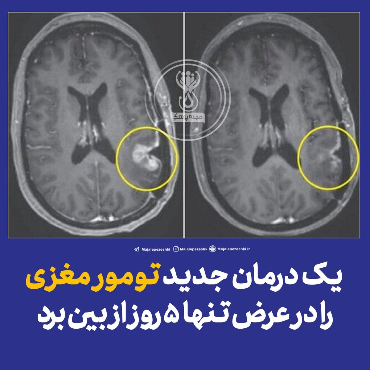 یک درمان جدید تومور مغزی را در عرض تنها ۵ روز از بین برد!