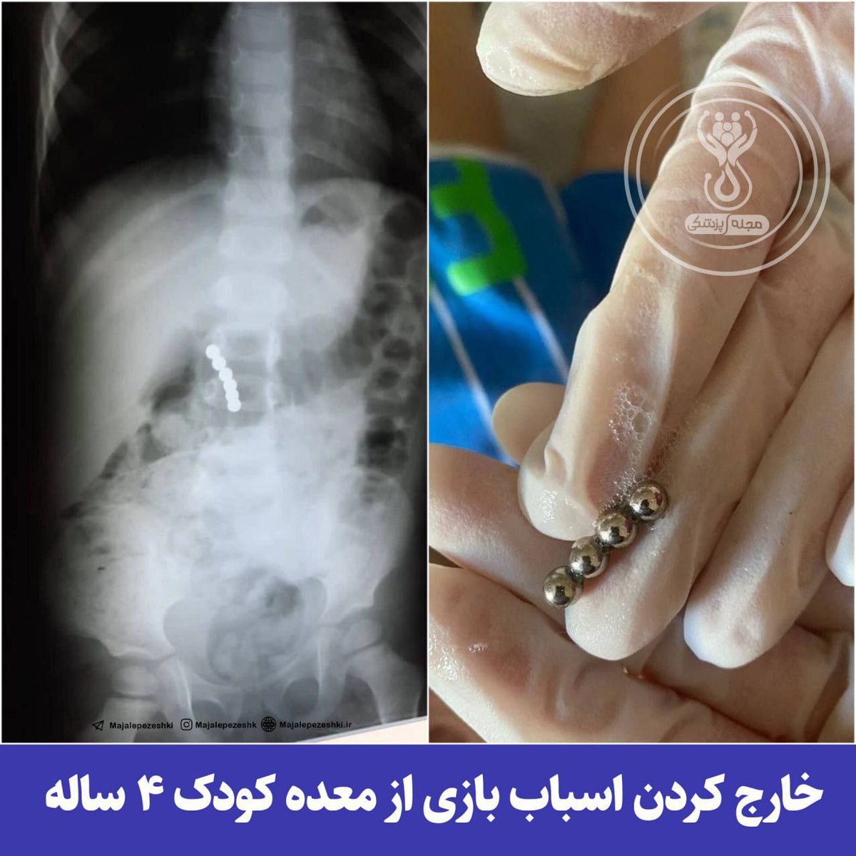 خارج کردن اسباب بازی از معده کودک ۴ ساله