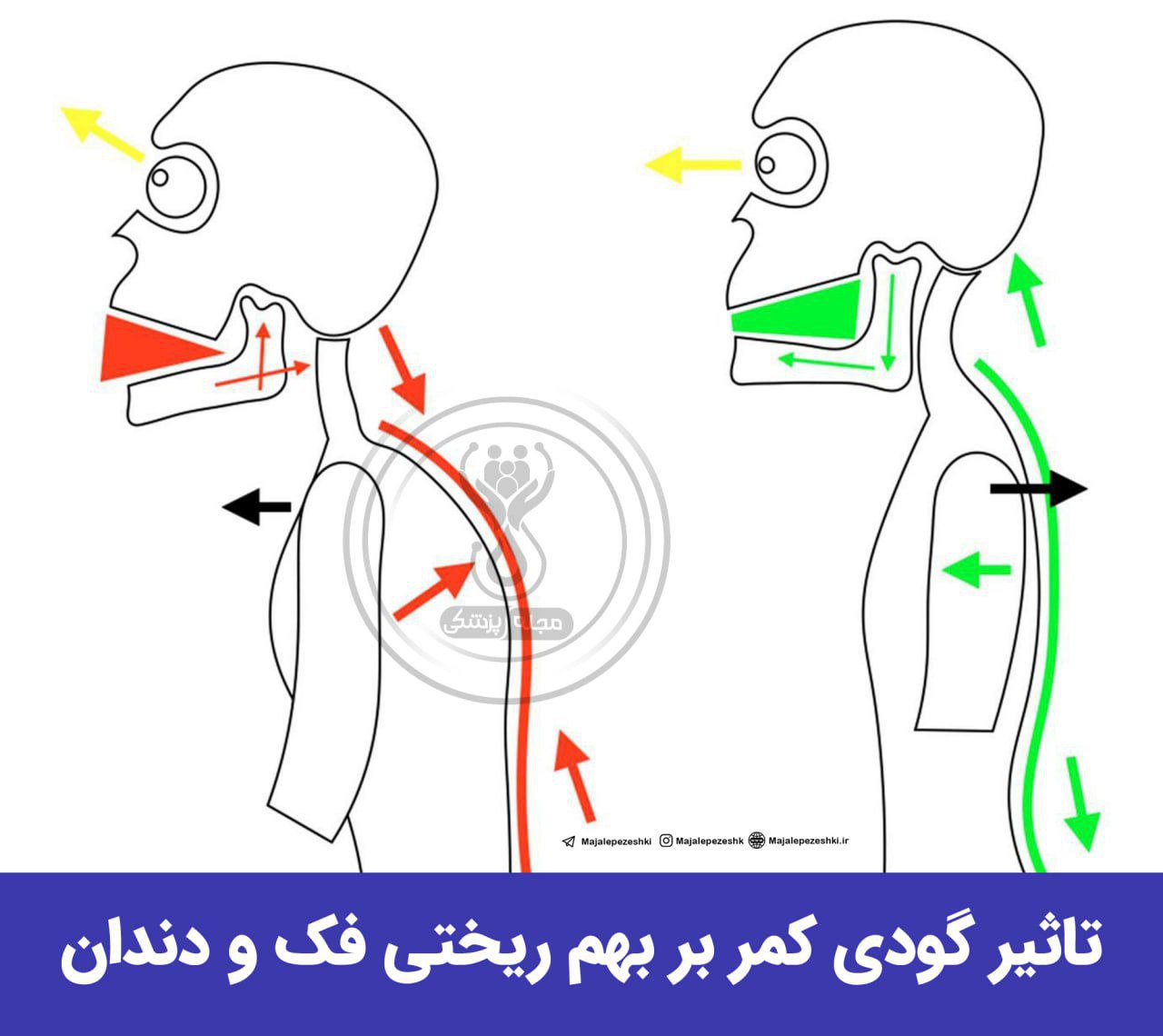 آیا گودی کمر بر روی فرم فک و دندان ها تاثیر دارد؟