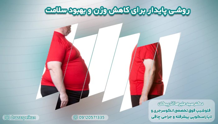 اسلیو معده: روشی پایدار برای کاهش وزن و بهبود سلامت