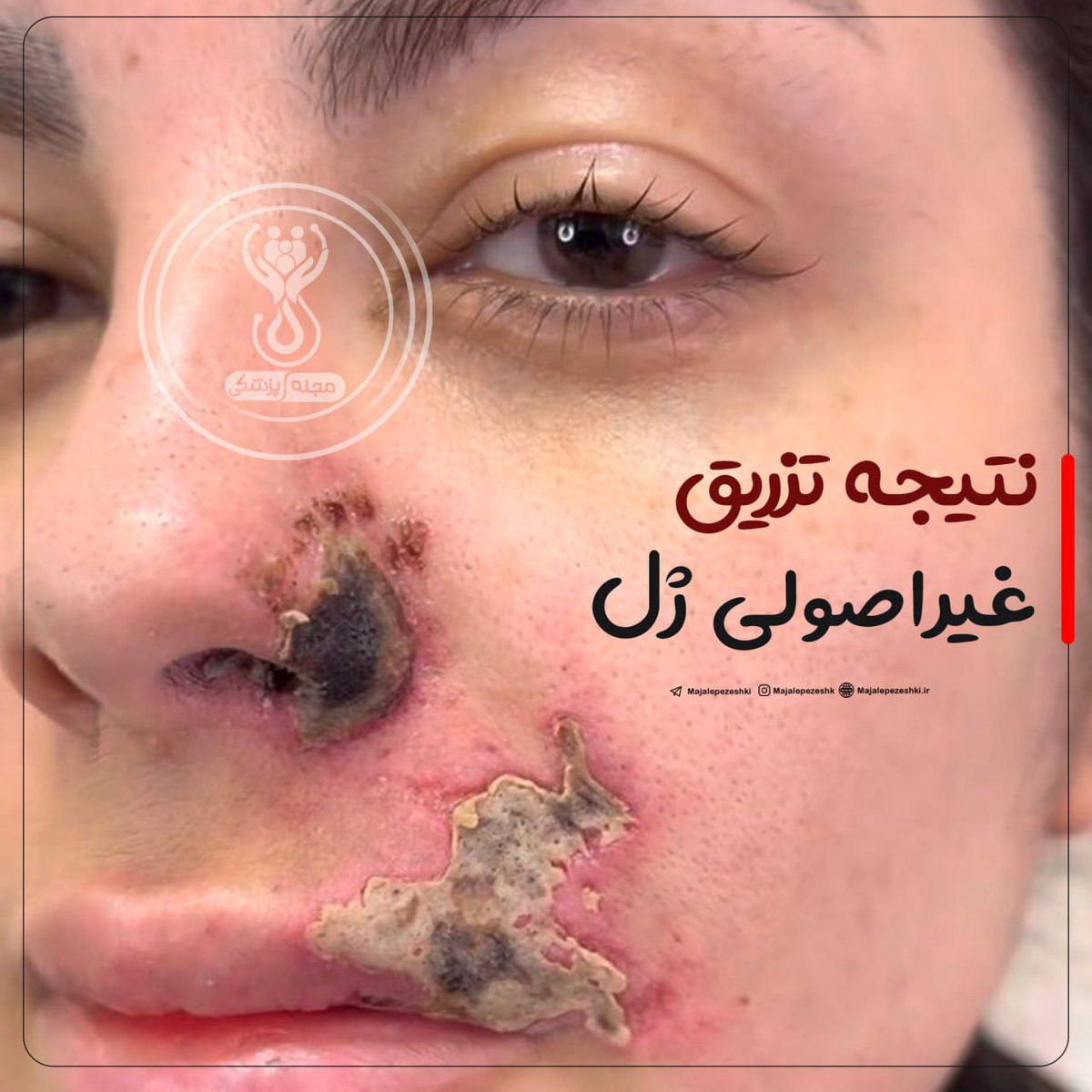نتیجه فاجعه بار تزریق غیراصولی ژل!