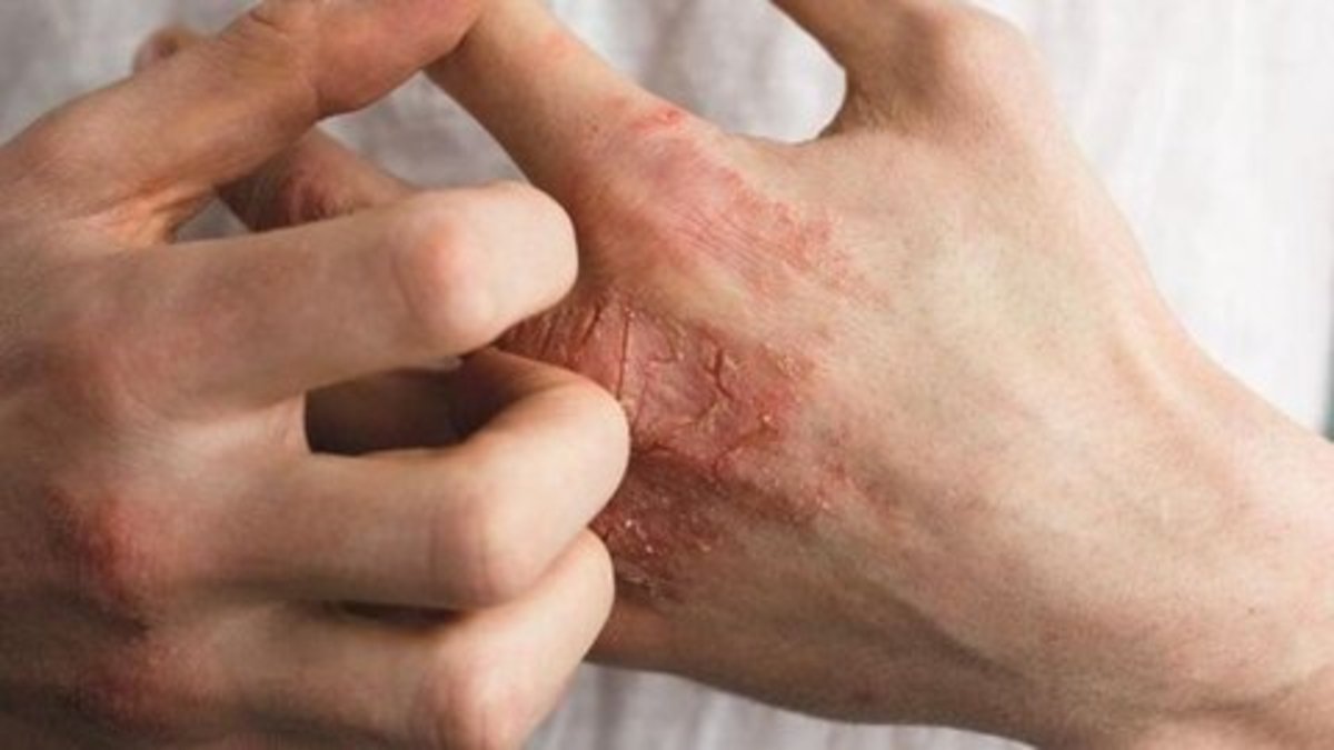 نشانه‌های پوستی بیماری کبدی کدام است؟