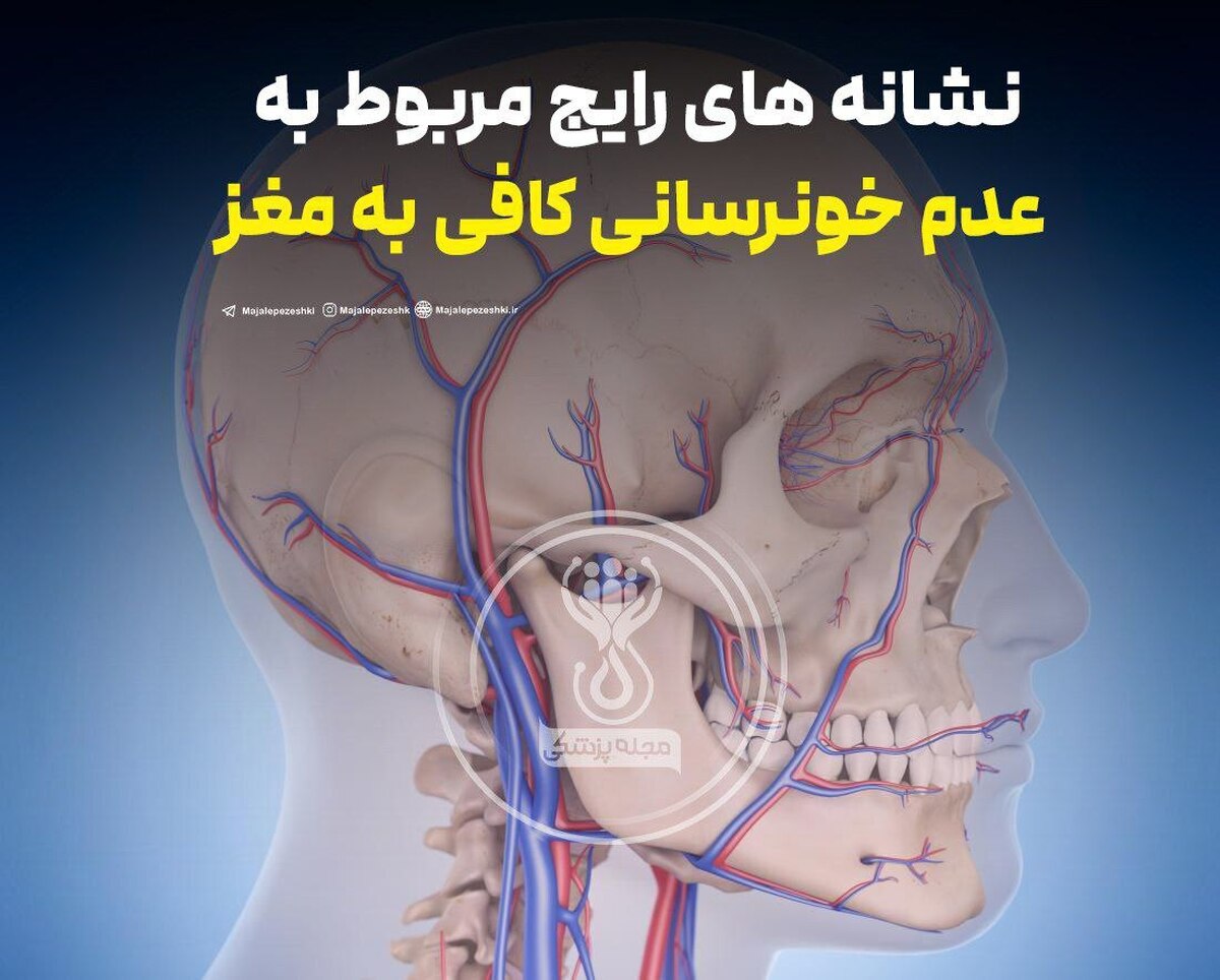 نشانه های رایج مربوط به عدم خونرسانی کافی به مغز
