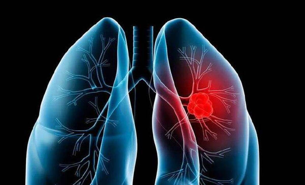 قرص جدید سرطان ریه در آزمایش‌های بالینی عملکرد قابل‌توجهی از خود نشان داد