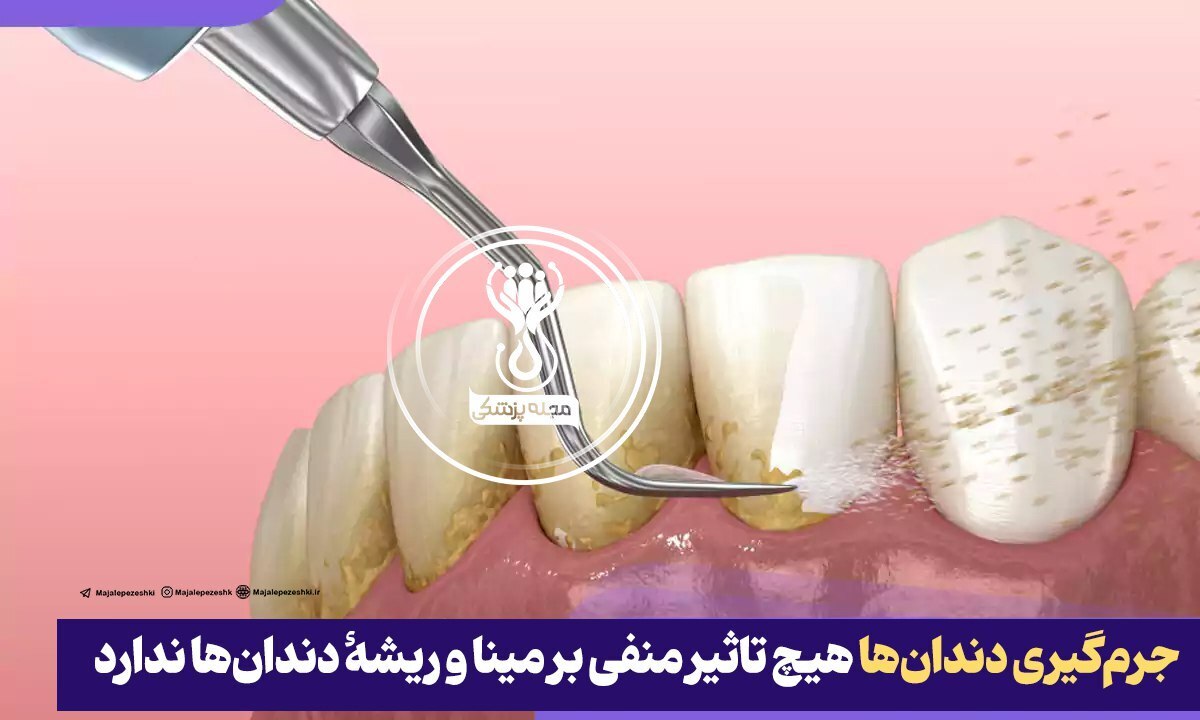 جرم‌گیری هیچ تاثیر منفی بر مینا و ریشهٔ دندان‌ها ندارد!