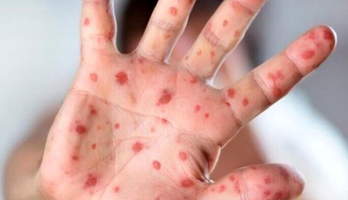 اگر واکسن نزنید تا ۹۰ درصد منتقل می‌شود