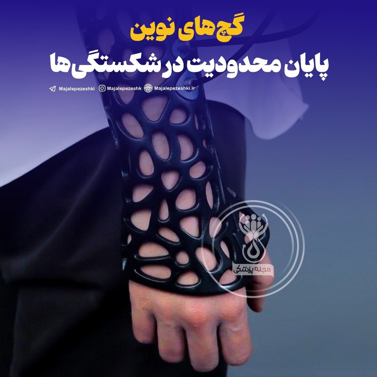 گچ‌های نوین، پایان محدودیت در شکستگی‌ها