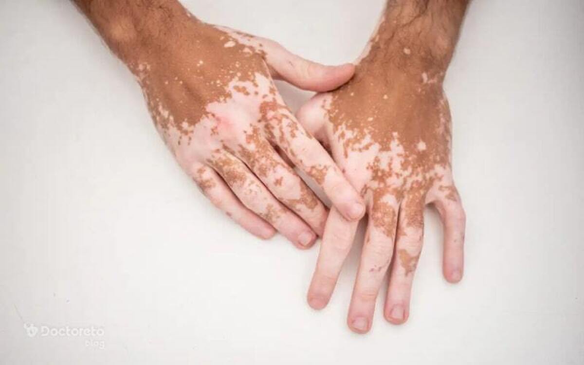 چرا بدن پیسی می‌گیرد؟