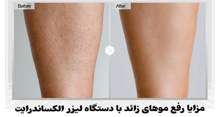 آشنایی کامل با لیزر الکساندرایت (مزایا، عوارض، اثر بخشی) آشنایی کامل با لیزر الکساندرایت (مزایا، عوارض، اثر بخشی)