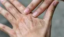 تأثیر خاموش آلودگی هوا بر سلامت و پیری پوست