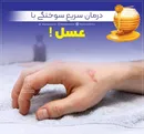 درمان سریع سوختگی با عسل !