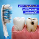 مسواک فرسوده احتمال پوسیدگی دندان را افزایش میدهد!
