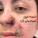 نتیجه فاجعه بار تزریق غیراصولی ژل!