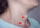 آنچه باید درباره پرکاری و کم کاری تیروئید بدانید