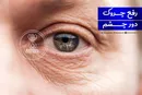رفع چروک دور چشم