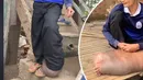 وضعیت عجیب پای پسر کامبوجی پس از گزش پشه!