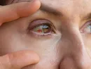 دلایل پارگی رگ خونی درچشم؛ چه موقع باید به پزشک مراجعه کنیم؟